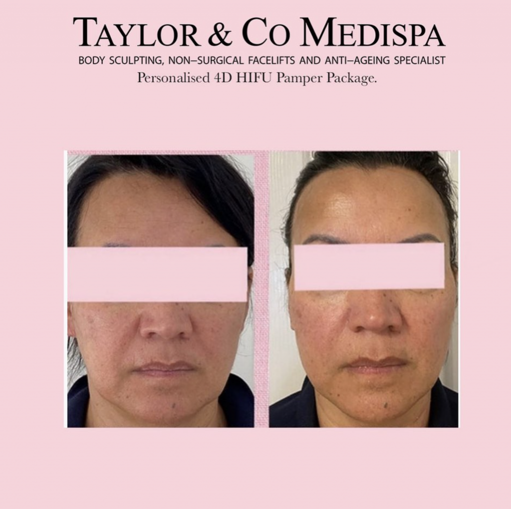 Taylor & Co Medispa HIFU Treatment, Before & after images.