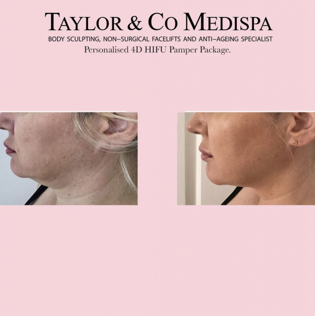 Taylor & Co Medispa HIFU Treatment, Before & after client images.