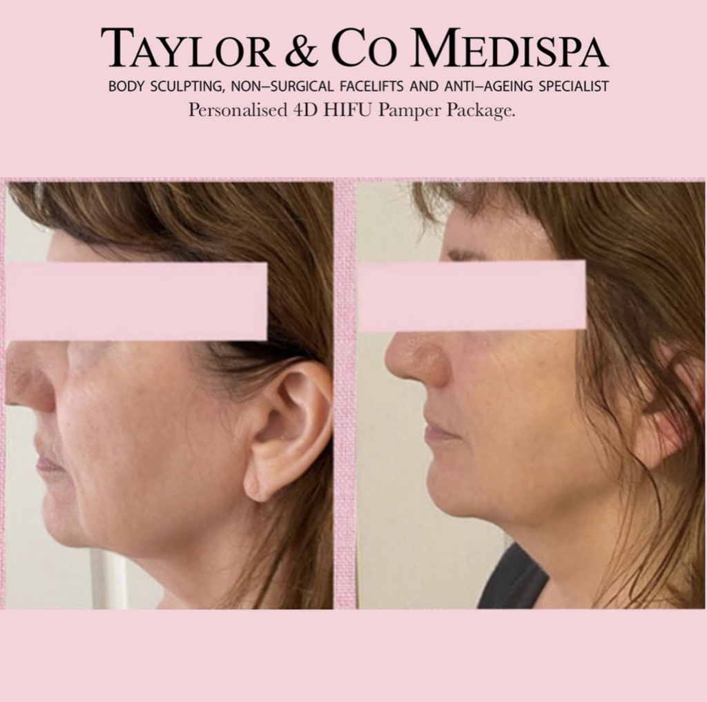 Taylor & Co Medispa HIFU Treatment, Before & after client images.