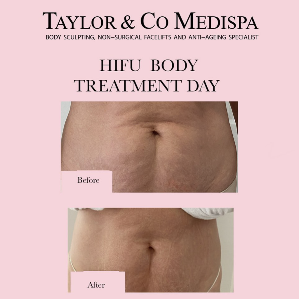 Taylor & Co Medispa Body HIFU Treatment, Before & after client images.